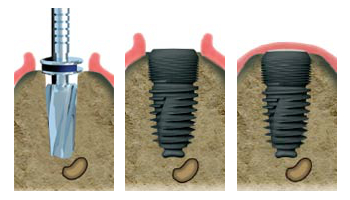 Protocole des implants du Centre dentaire Nice Nice Centre dentaire Protocole des implants